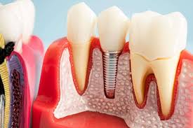 Dental Implants