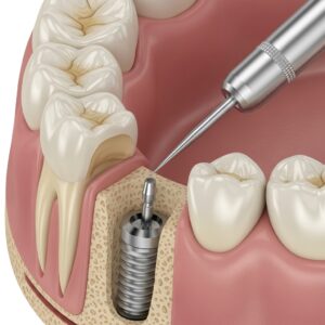 dental implants procedgure