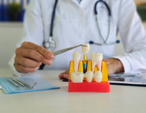 dental implants