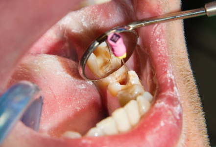 Canal Treatment