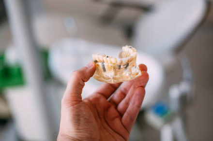 Dental Implants