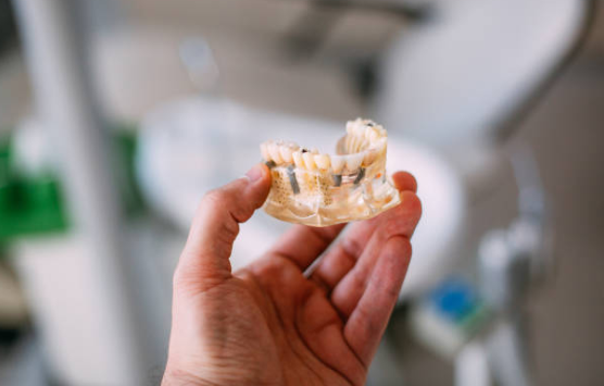 Dental Implant Procedure