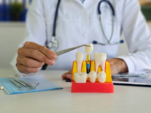 Dental Implants