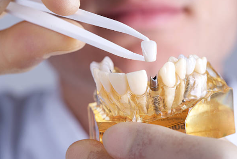 Dental Implants