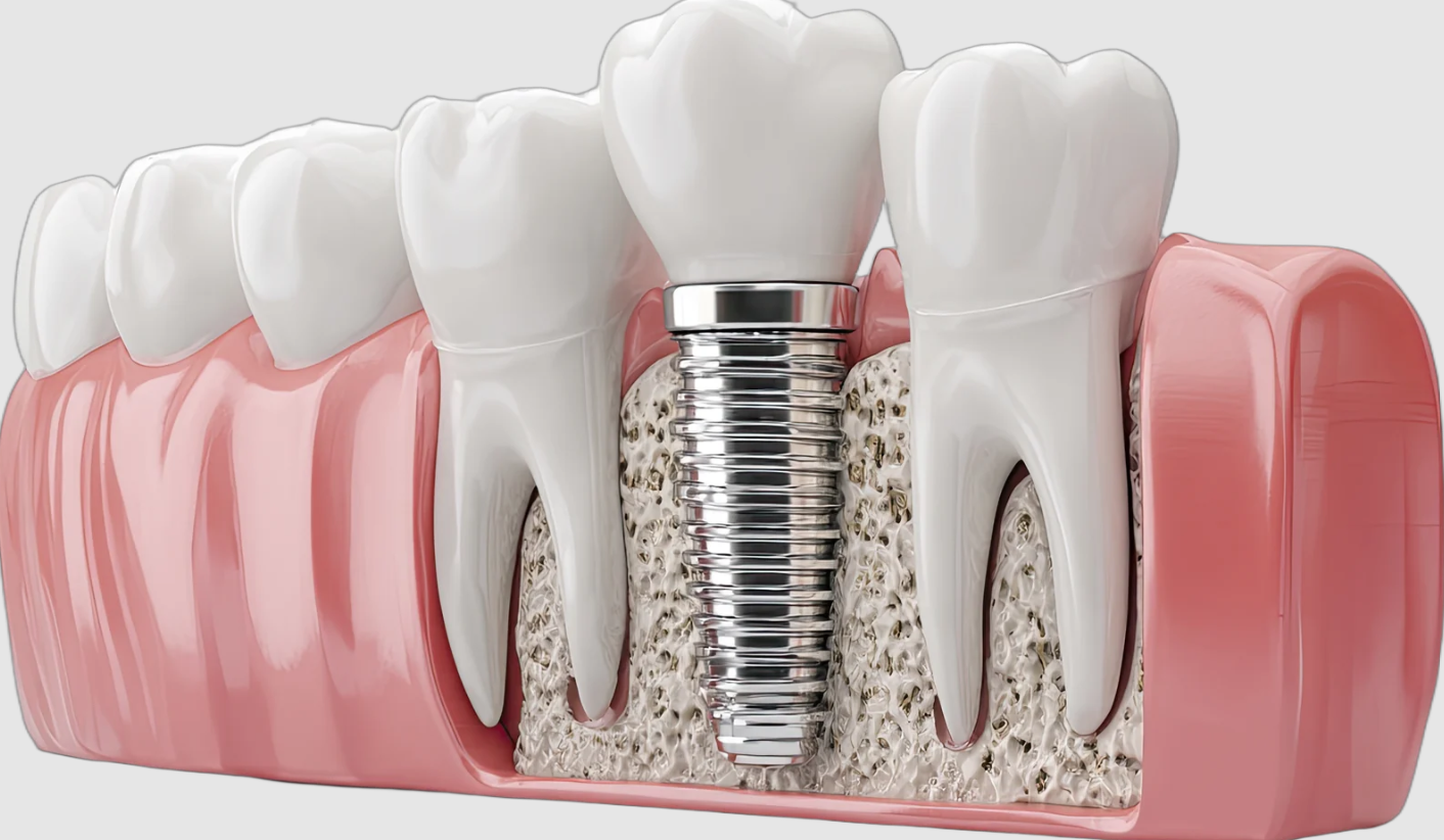 Who Is Most at Risk for Dental Implant Complications?