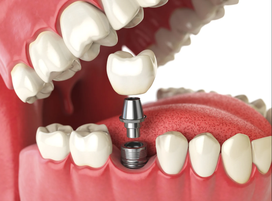 What Does the Dental Implant Procedure Involve?
