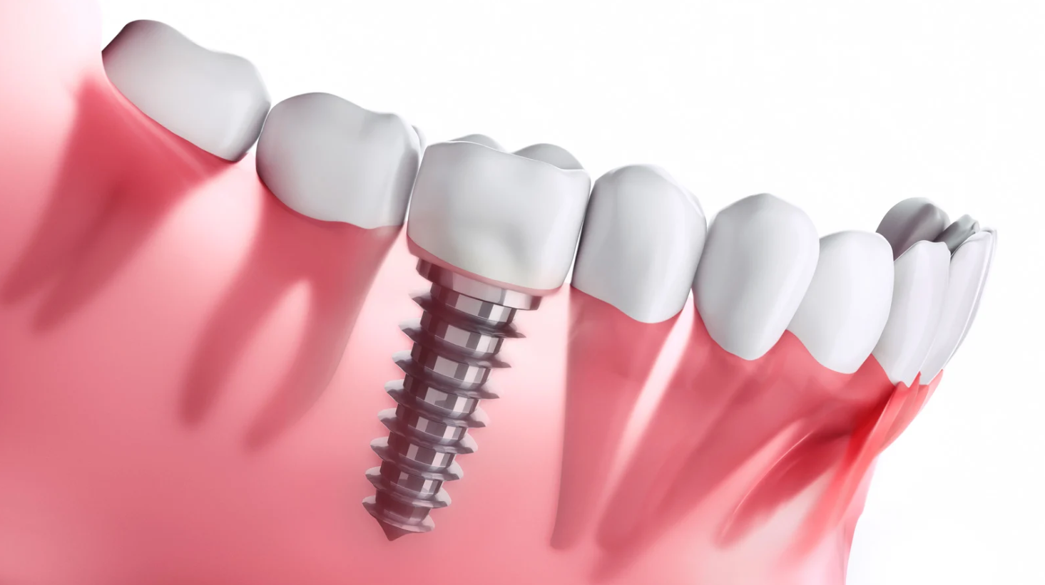 What Does a Full Set of Implants Include?