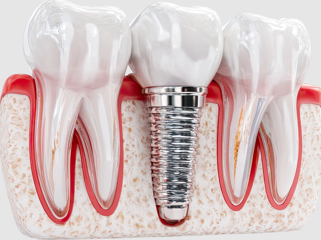 What Are the 3 Types of Dental Implants?
