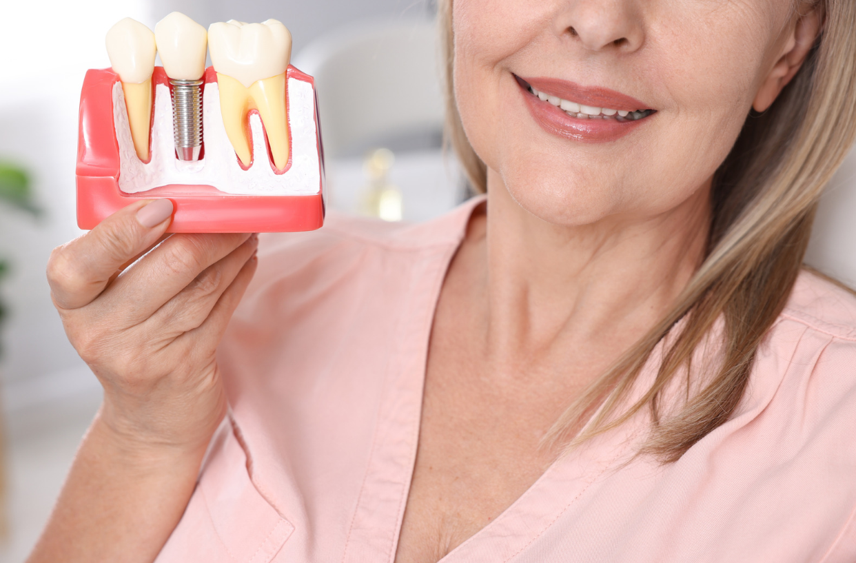What Are the Benefits of Dental Implants?