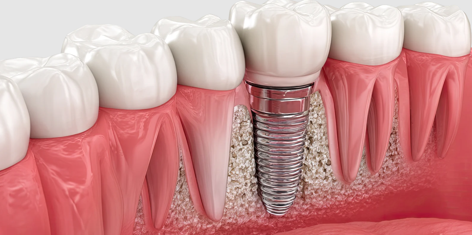 Benefits of Choosing Dental Implants